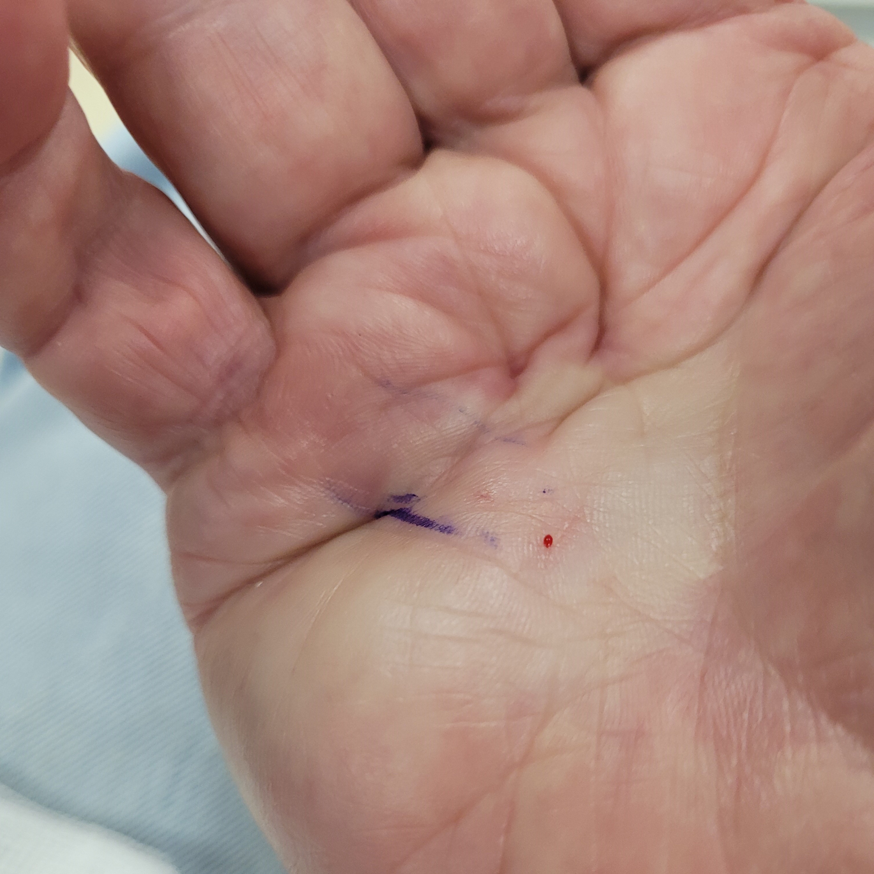 Three cheers for the NHS (again)! (Dupuytrens 1)